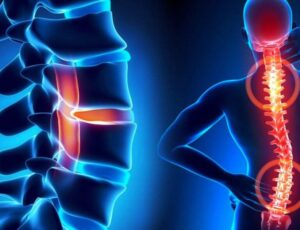 Herniated-Disc-ORTHOPEDICS & SPORTS RELATED REHABILITATION